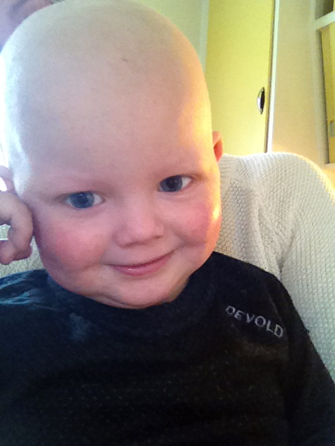 Edvin mistet håret, og ansiktet forandret seg også. Det er vanlige bivirkninger av kreftbehandlinga. (Foto: Privat)